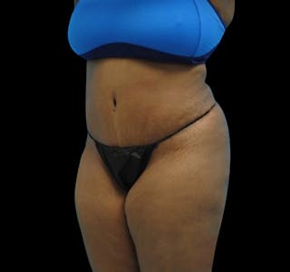 Tummy Tuck Before & After Gallery - Patient 55432698 - Image 4