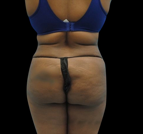 Tummy Tuck Before & After Gallery - Patient 55432698 - Image 6