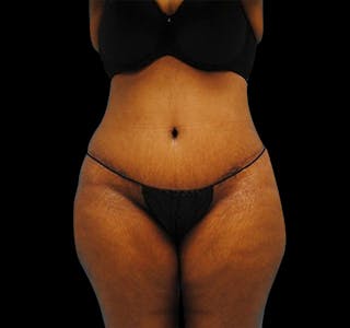 Tummy Tuck Before & After Gallery - Patient 55432700 - Image 2