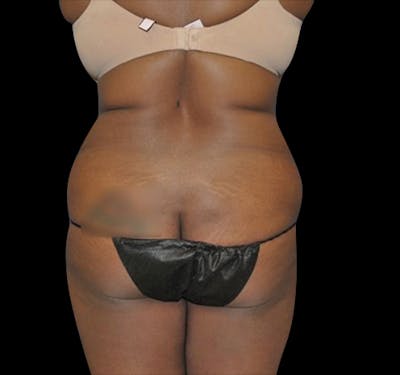 New Jersey Tummy Tuck Before & After Gallery - Patient 55432698 - Image 5