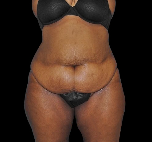New Jersey Tummy Tuck Before & After Gallery - Patient 55432700 - Image 1