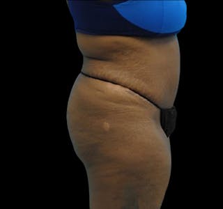 New Jersey Tummy Tuck Before & After Gallery - Patient 55432698 - Image 8