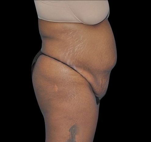 New Jersey Tummy Tuck Before & After Gallery - Patient 55432698 - Image 7