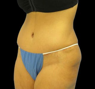 New Jersey Tummy Tuck Before & After Gallery - Patient 55432699 - Image 4