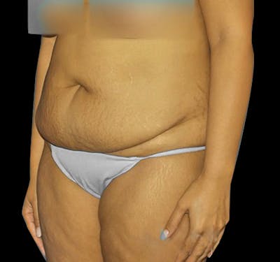 New Jersey Tummy Tuck Before & After Gallery - Patient 55432699 - Image 3
