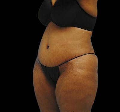 Tummy Tuck Before & After Gallery - Patient 55432700 - Image 6