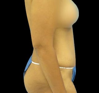 New Jersey Tummy Tuck Before & After Gallery - Patient 55432699 - Image 6