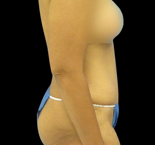 New Jersey Tummy Tuck Before & After Gallery - Patient 55432699 - Image 6
