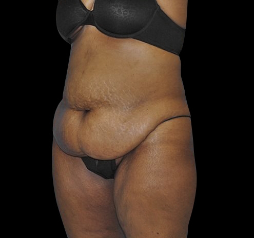 Tummy Tuck Before & After Gallery - Patient 55432700 - Image 5