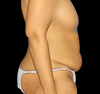 New Jersey Tummy Tuck Before & After Gallery - Patient 55432699 - Image 5