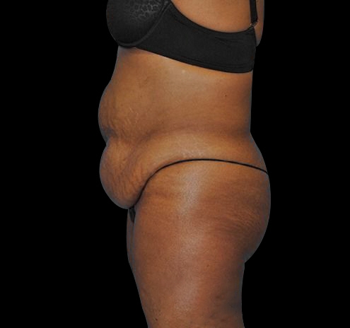 New Jersey Tummy Tuck Before & After Gallery - Patient 55432700 - Image 7