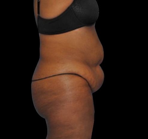 Tummy Tuck Before & After Gallery - Patient 55432700 - Image 9