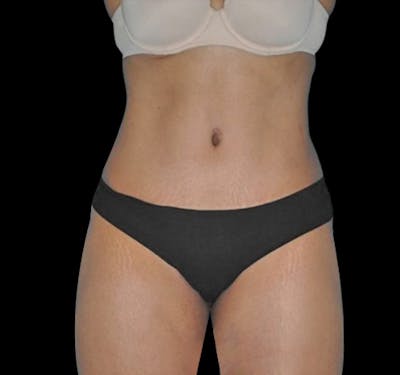 New Jersey Tummy Tuck Before & After Gallery - Patient 55432701 - Image 2