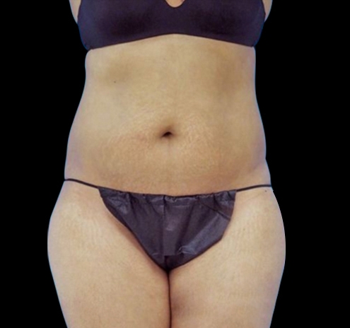 Tummy Tuck Before & After Gallery - Patient 55432701 - Image 1