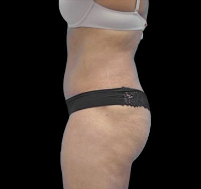 Tummy Tuck Before & After Gallery - Patient 55432701 - Image 4