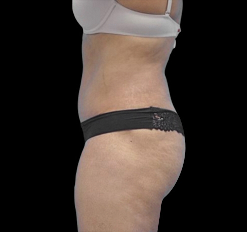 New Jersey Tummy Tuck Before & After Gallery - Patient 55432701 - Image 4