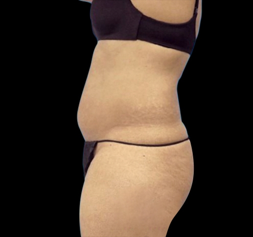 New Jersey Tummy Tuck Before & After Gallery - Patient 55432701 - Image 3
