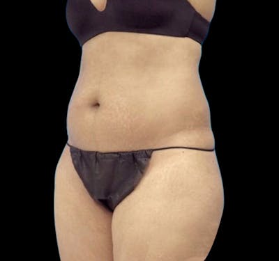New Jersey Tummy Tuck Before & After Gallery - Patient 55432701 - Image 5