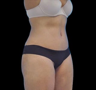 New Jersey Tummy Tuck Before & After Gallery - Patient 55432701 - Image 8