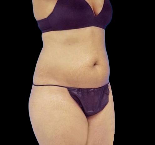 New Jersey Tummy Tuck Before & After Gallery - Patient 55432701 - Image 7