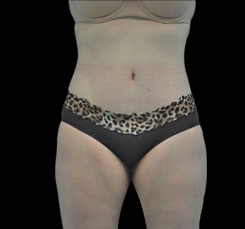 Tummy Tuck Before & After Gallery - Patient 55432706 - Image 2