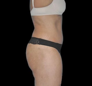 Tummy Tuck Before & After Gallery - Patient 55432701 - Image 10