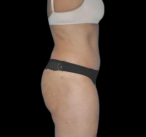 Tummy Tuck Before & After Gallery - Patient 55432701 - Image 10