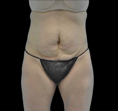 New Jersey Tummy Tuck Before & After Gallery - Patient 55432706 - Image 1