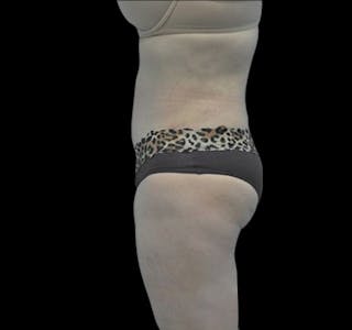 New Jersey Tummy Tuck Before & After Gallery - Patient 55432706 - Image 4