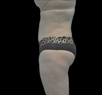 Tummy Tuck Before & After Gallery - Patient 55432706 - Image 4