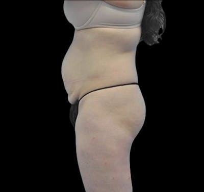 New Jersey Tummy Tuck Before & After Gallery - Patient 55432706 - Image 3