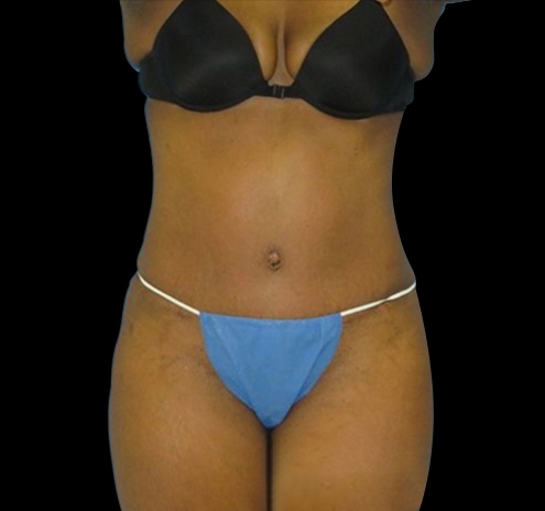 Tummy Tuck Before & After Gallery - Patient 55432712 - Image 2