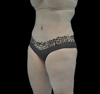 Tummy Tuck Before & After Gallery - Patient 55432706 - Image 6