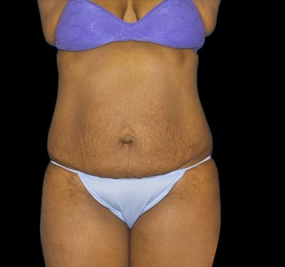Tummy Tuck Before & After Gallery - Patient 55432712 - Image 1