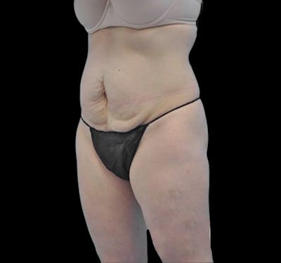 Tummy Tuck Before & After Gallery - Patient 55432706 - Image 5