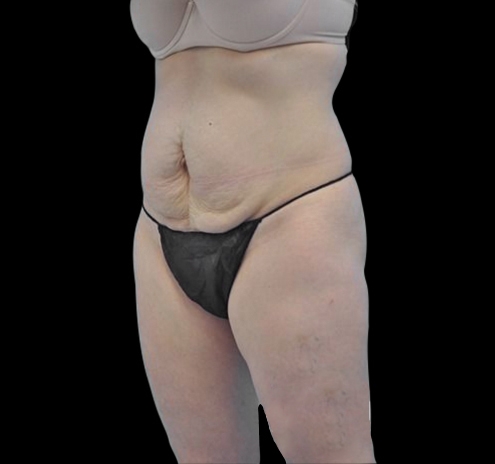 New Jersey Tummy Tuck Before & After Gallery - Patient 55432706 - Image 5