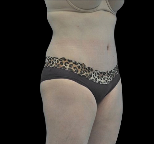 New Jersey Tummy Tuck Before & After Gallery - Patient 55432706 - Image 8