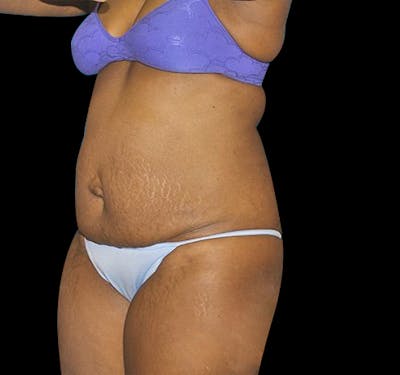 New Jersey Tummy Tuck Before & After Gallery - Patient 55432712 - Image 3