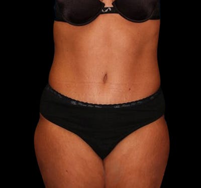 New Jersey Tummy Tuck Before & After Gallery - Patient 55432714 - Image 2