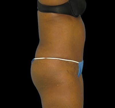 Tummy Tuck Before & After Gallery - Patient 55432712 - Image 6