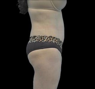 New Jersey Tummy Tuck Before & After Gallery - Patient 55432706 - Image 10