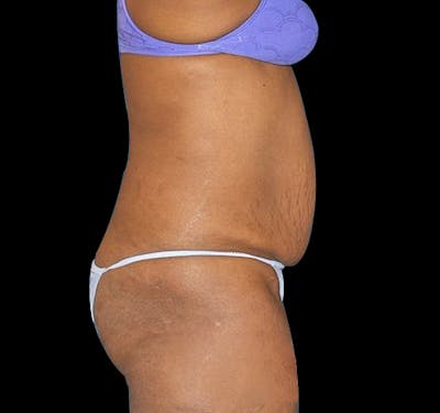 Tummy Tuck Before & After Gallery - Patient 55432712 - Image 5