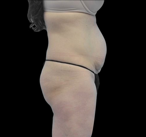 New Jersey Tummy Tuck Before & After Gallery - Patient 55432706 - Image 9