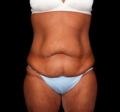 New Jersey Tummy Tuck Before & After Gallery - Patient 55432714 - Image 1