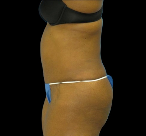 Tummy Tuck Before & After Gallery - Patient 55432712 - Image 8