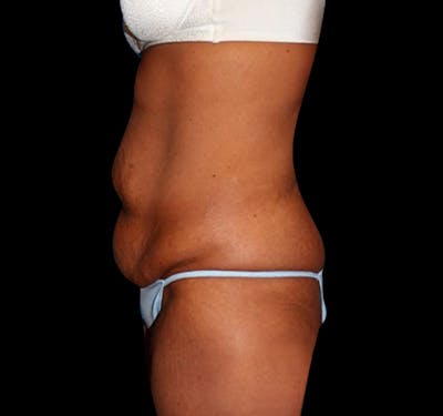 New Jersey Tummy Tuck Before & After Gallery - Patient 55432714 - Image 3