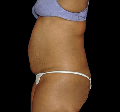 Tummy Tuck Before & After Gallery - Patient 55432712 - Image 7