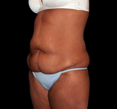 New Jersey Tummy Tuck Before & After Gallery - Patient 55432714 - Image 5