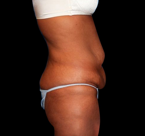 Tummy Tuck Before & After Gallery - Patient 55432714 - Image 7