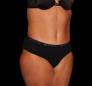 Tummy Tuck Before & After Gallery - Patient 55432714 - Image 10